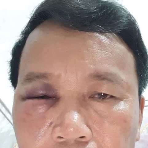 Quảng Bình: Chủ tịch bị nguyên chủ tịch xã “múc” bầm mắt